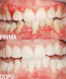 Gengivite associata ad accumuli di placca e tartaro Grave gengivite associata ad accumuli di placca e tartaro trattata con levigatura radicolare.