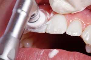 Lucidatura professionale dei denti