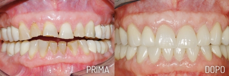 Faccette Estetiche - Studio Odontoiatrico De Palma - Giovinazzo Faccette Estetiche - Studio Odontoiatrico De Palma - Giovinazzo