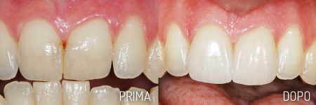 Faccette Estetiche - Studio Dentistico De Palma - Giovinazzo Faccette Estetiche - Studio Dentistico De Palma - Giovinazzo