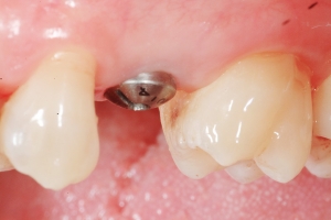 Impianto dentale - Fase: inserimento impianto nell’osso mascellare o mandibolare. Impianto dentale - Fase: inserimento impianto nell’osso mascellare o mandibolare.