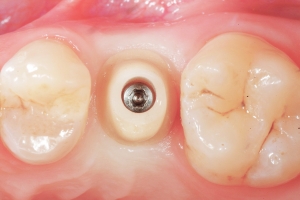 Impianto dentale - Fase 2: Scopertura dell\'impianto endosseo Impianto dentale - Fase 2: Scopertura dell\'impianto endosseo