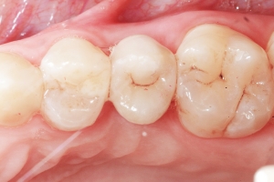 Impianto dentale - Fase 3: Corona cementata sull\'impianto. Impianto dentale - Fase 3: Corona cementata sull\'impianto.