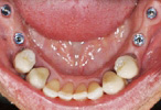 Esempio impianto dentale - Arcata superiore