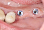 Implantologia dentale - elementi protesici