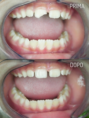 Ortodonzia Pediatrica: Ricostruzione del frammento del dente Ortodonzia Pediatrica: Ricostruzione del frammento del dente